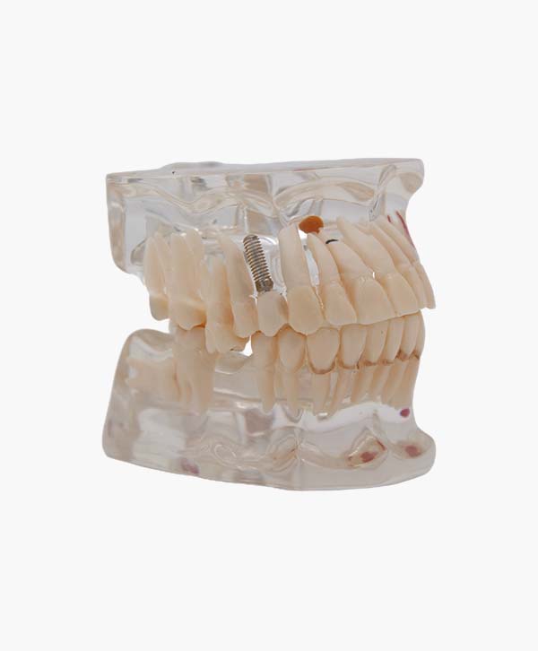 orthodontic model-20