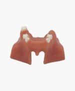 maxillary sinus lifting-10