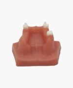 maxillary sinus lifting-6