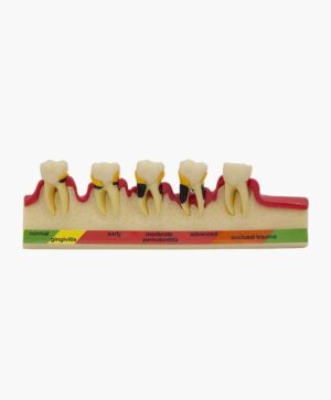 periodontal disease-3