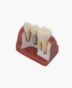 teeth implanting model-1