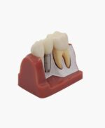 teeth implanting model-2