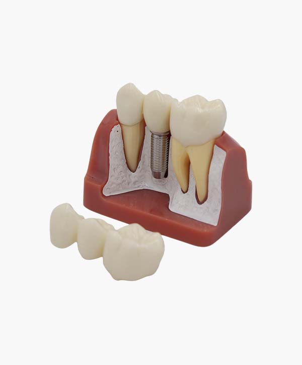 teeth implanting model-3