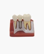 teeth implanting model-4