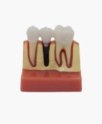 teeth implanting model-7